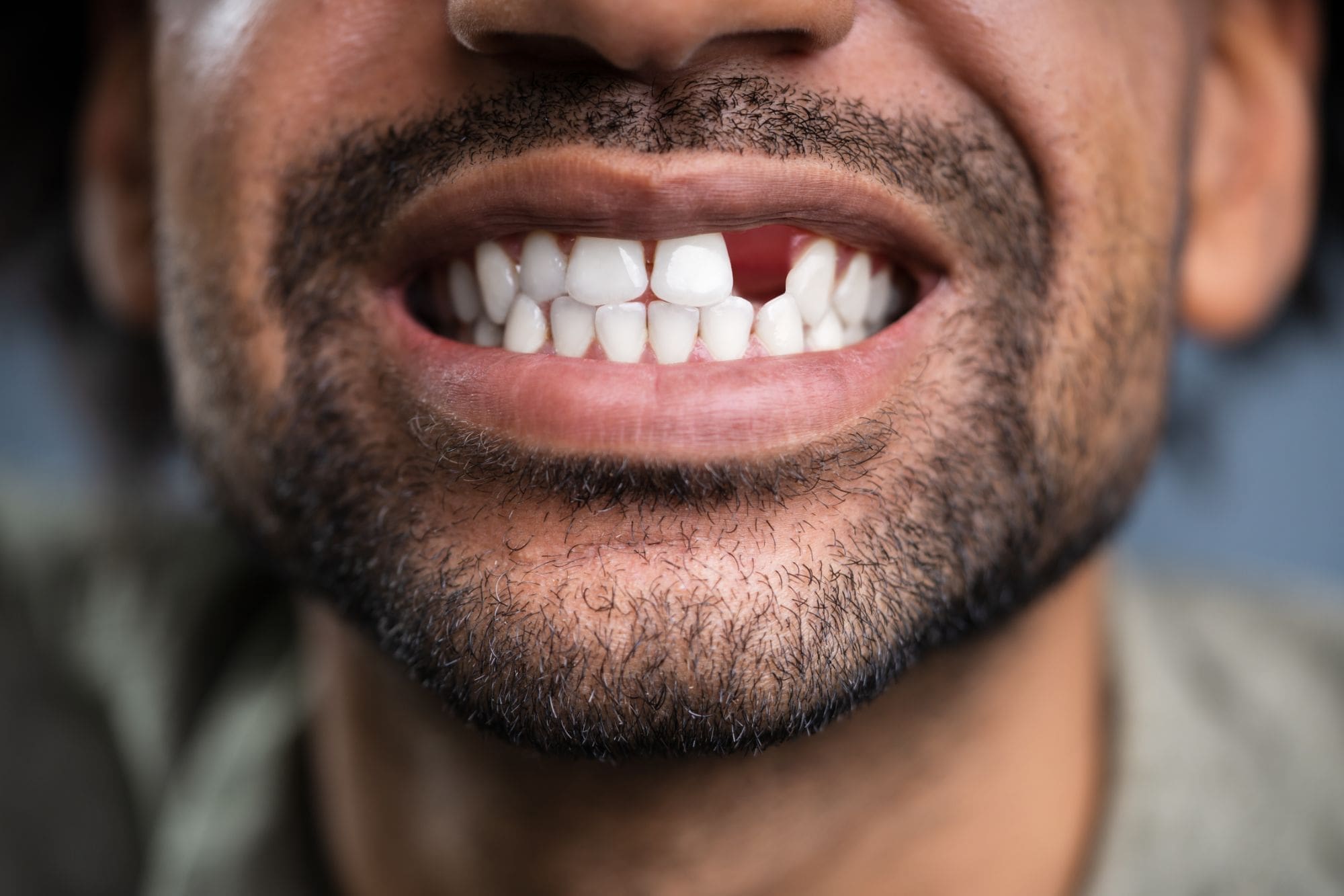 A close-up of a person with a beard smiling and showing missing upper front teeth.