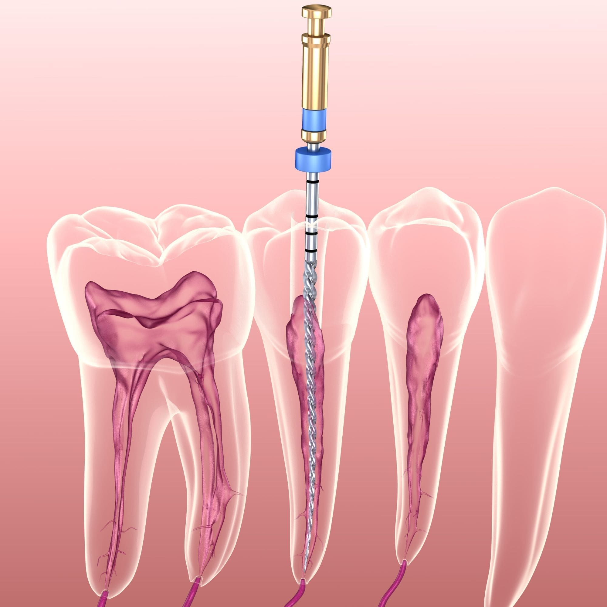 Digital illustration of a dental root canal procedure showing a file instrument cleaning inside the root canal of a tooth, with surrounding teeth and roots visible.
