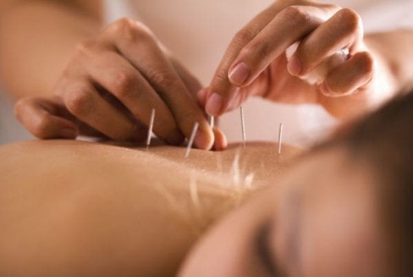 A close-up of a person receiving acupuncture, with several thin needles inserted into their bare back while a practitioners hands carefully place another needle. The persons face is blurred in the foreground.